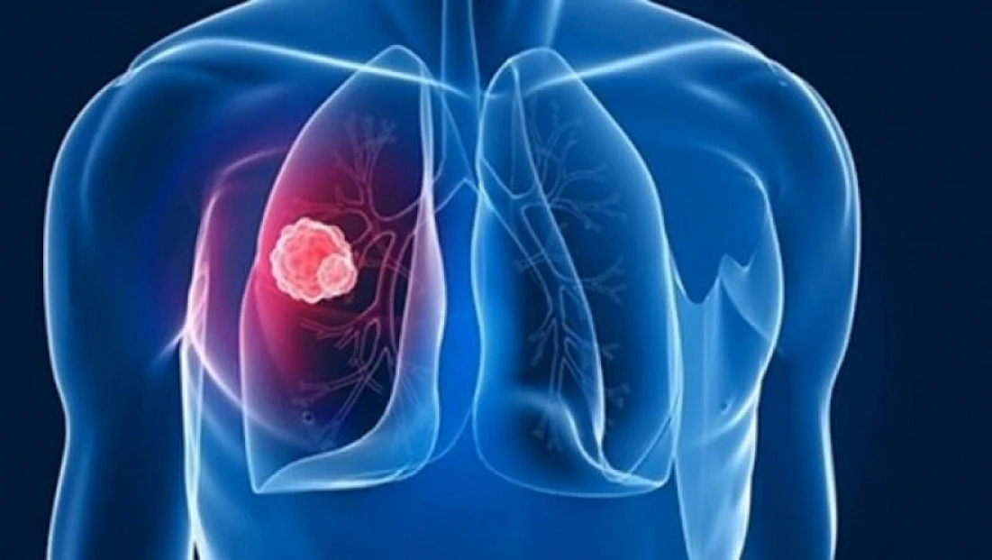 DSÖ Uyardı: Tüberküloz her yıl 1,2 milyondan fazla insanın hayatına mal oluyor