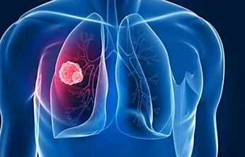 DSÖ Uyardı: Tüberküloz her yıl 1,2 milyondan fazla insanın hayatına mal oluyor