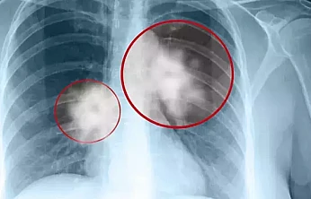 Düşük Doz BT ile Akciğer Kanserinde erken tanı mümkün