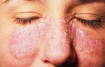 Lupus hastalığı kadınlarda 9 kat daha fazla görülüyor