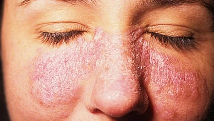 Lupus hastalığı kadınlarda 9 kat daha fazla görülüyor