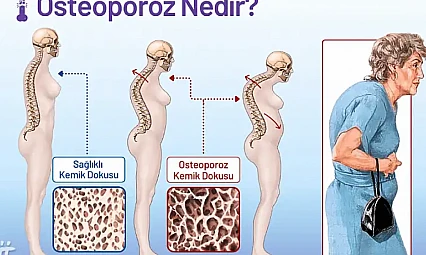 Kemik erimesine karşı doğru beslenme hayati önem taşıyor
