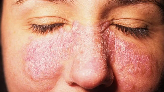 Lupus hastalığı kadınlarda 9 kat daha fazla görülüyor