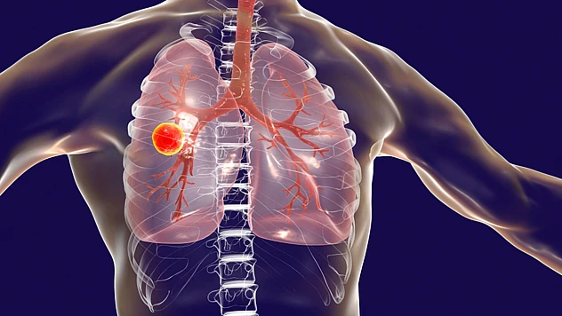 Tüberküloz Bir Öksürükle Yayılır