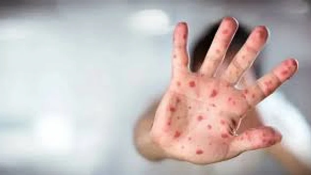 Uzmanlardan aşı uyarısı: Kızamık vakaları yeniden yükselişte