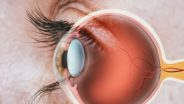 Retina yırtığı körlüğe neden olabilir