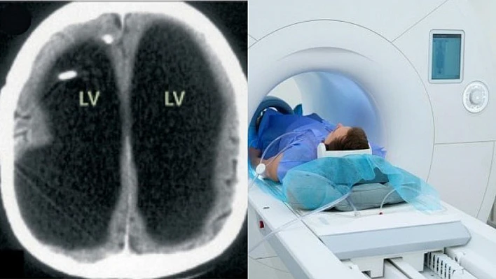 Tıp dünyasını şaşırtan vaka: Beyninin yarısı eksik çıktı!
