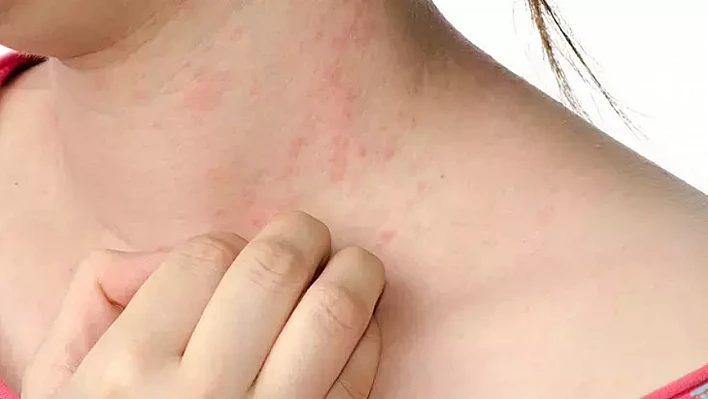 Yumurta alerjisi olanlar dikkat! Grip aşısı öncesi doktora danışın