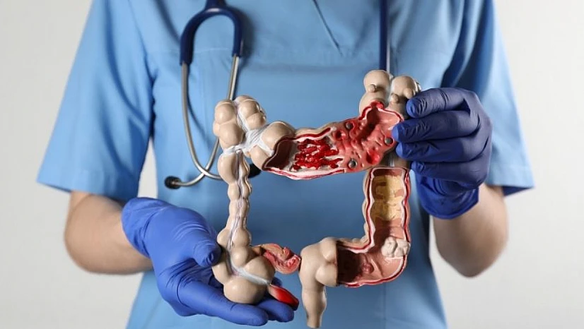 Bu gıdalar kolon kanseri riskini artırıyor