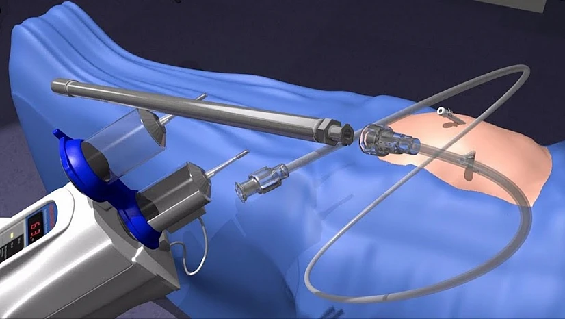 Karın zarı metastazında yeni umut: HIPEC ve PIPAC yöntemleri