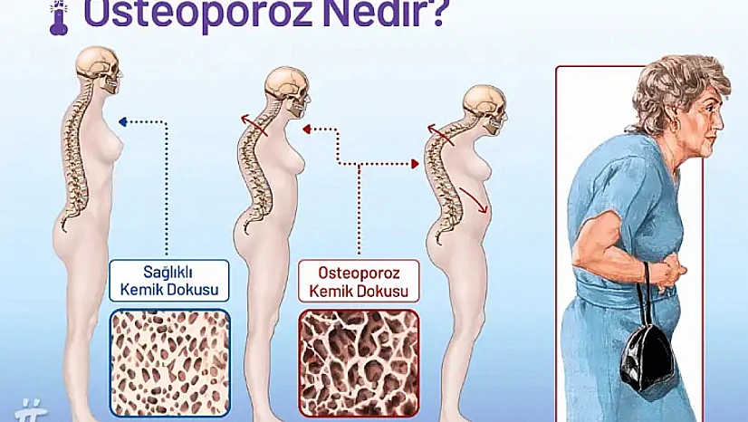 Kemik erimesine karşı doğru beslenme hayati önem taşıyor