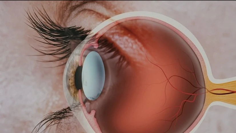 Retina yırtığına lazer tedavisi ile erken müdahale mümkün!