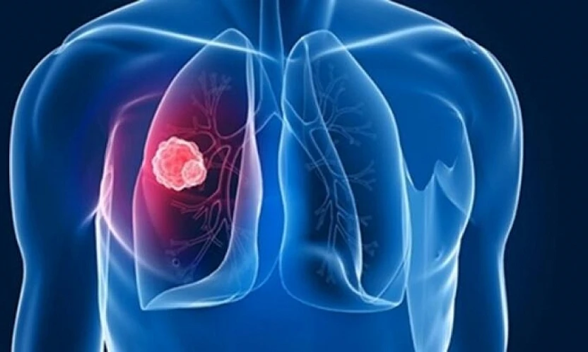 DSÖ Uyardı: Tüberküloz her yıl 1,2 milyondan fazla insanın hayatına mal oluyor