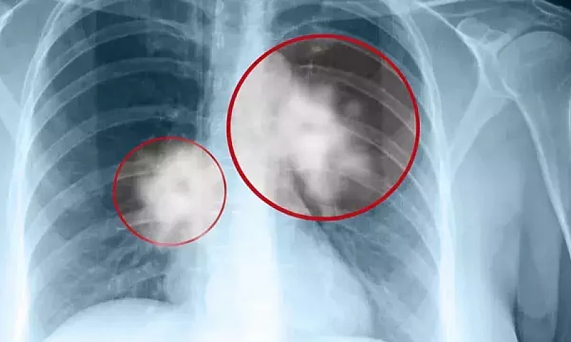 Düşük Doz BT ile Akciğer Kanserinde erken tanı mümkün