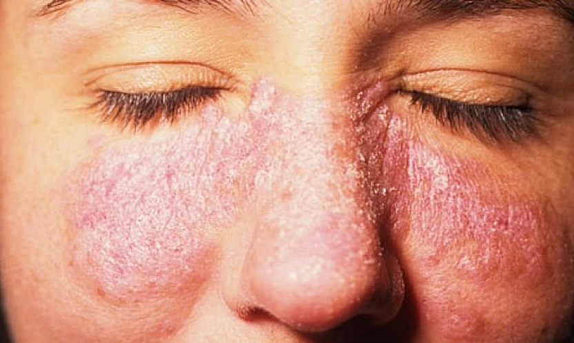 Lupus hastalığı kadınlarda 9 kat daha fazla görülüyor